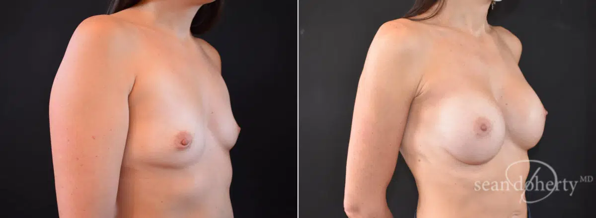 Breast Augmentation Before and After Photos in Boston, MA, Patient 8372