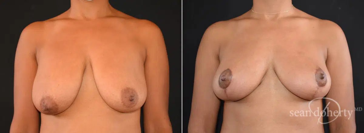 Patient 8382, Breast Lift Before and After Photos Breast Lift Before and After Photos in Boston, MA, Patient 8382