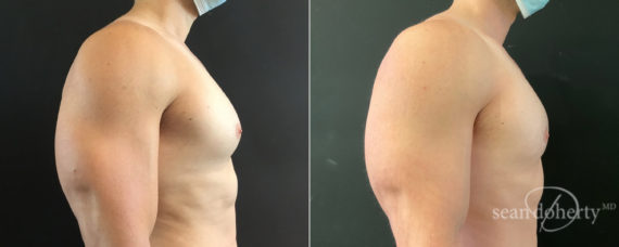 Gynecomastia Before and After Photos in Boston, MA, Patient 8417