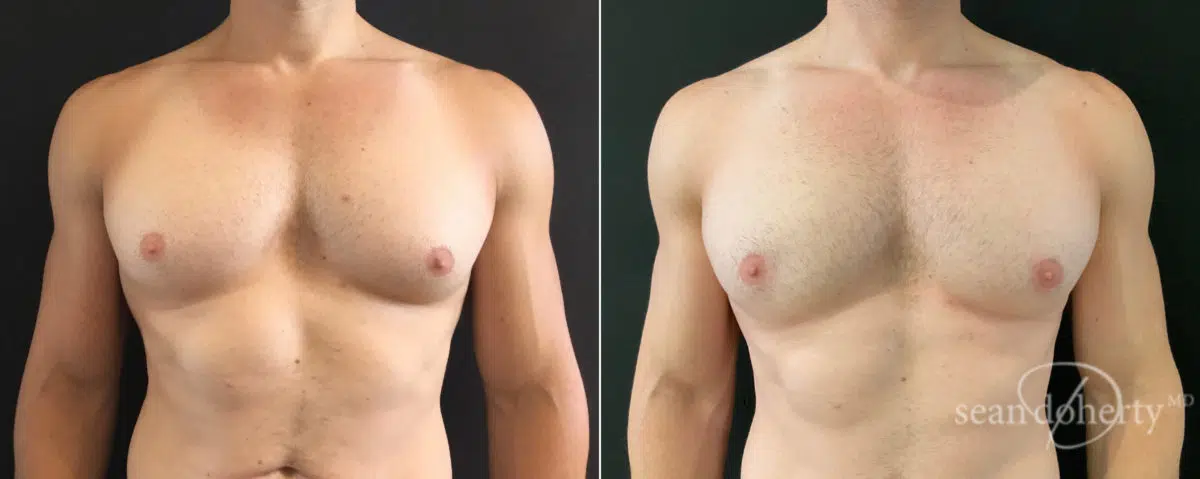 Gynecomastia Before and After Photos in Boston, MA, Patient 8417