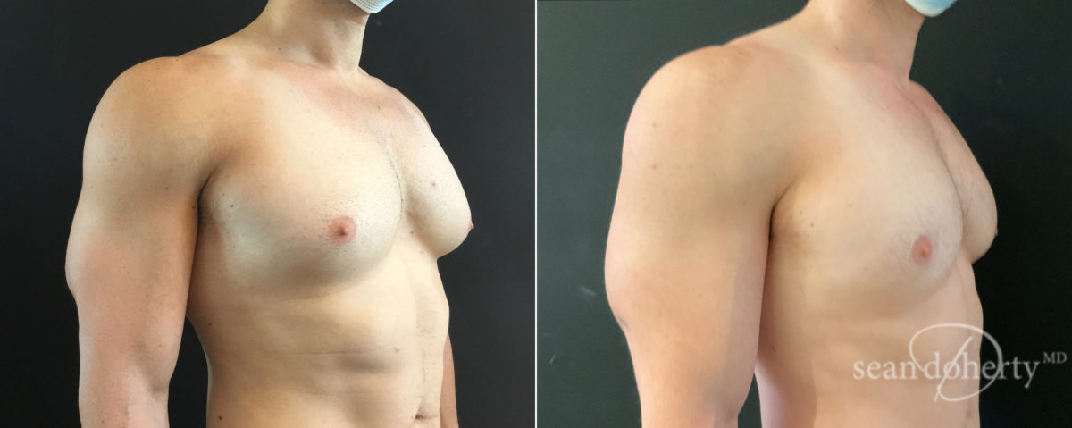 Gynecomastia Before and After Photos in Boston, MA, Patient 8417