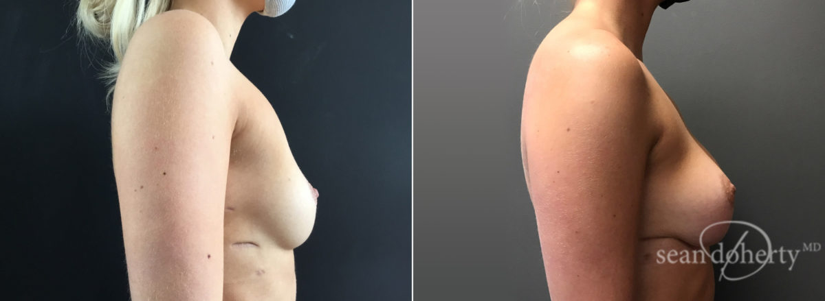 Breast Augmentation Before and After Photos in Boston, MA, Patient 8424