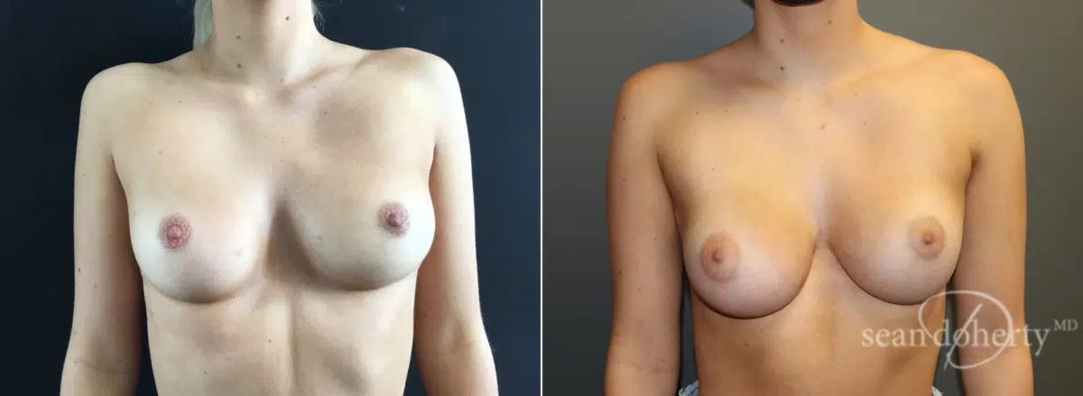 Breast Augmentation Before and After Photos in Boston, MA, Patient 8424