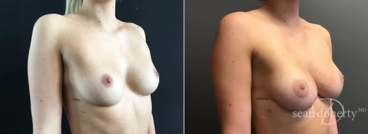 Breast Augmentation Before and After Photos in Boston, MA, Patient 8424