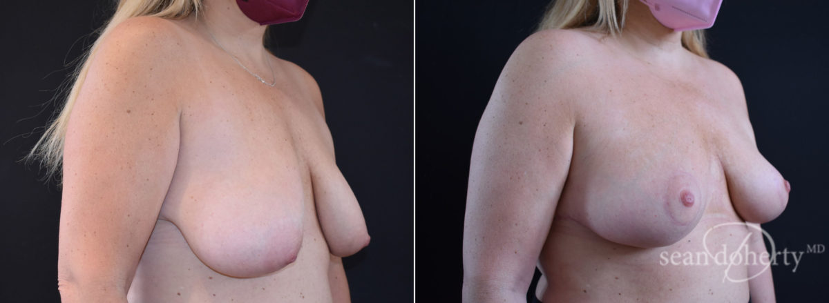Patient 8434, Breast Lift Before and After Photos Breast Lift Before and After Photos in Boston, MA, Patient 8434
