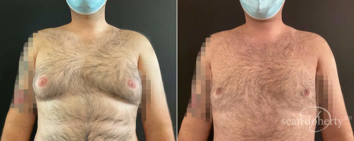 Gynecomastia Before and After Photos in Boston, MA, Patient 8444