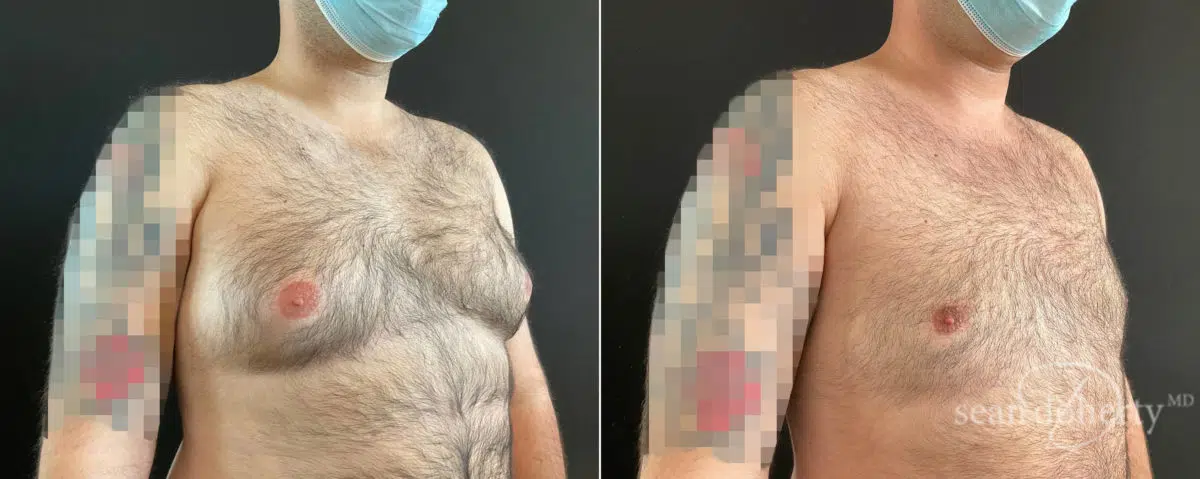 Gynecomastia Before and After Photos in Boston, MA, Patient 8444