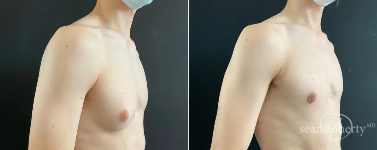 Gynecomastia Before and After Photos in Boston, MA, Patient 8451