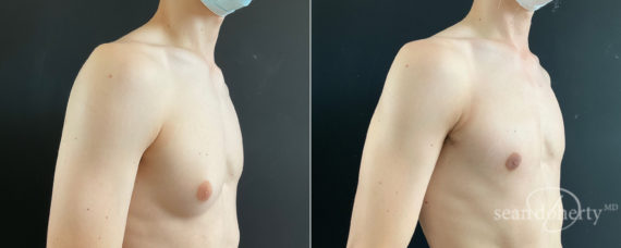 Gynecomastia Before and After Photos in Boston, MA, Patient 8451