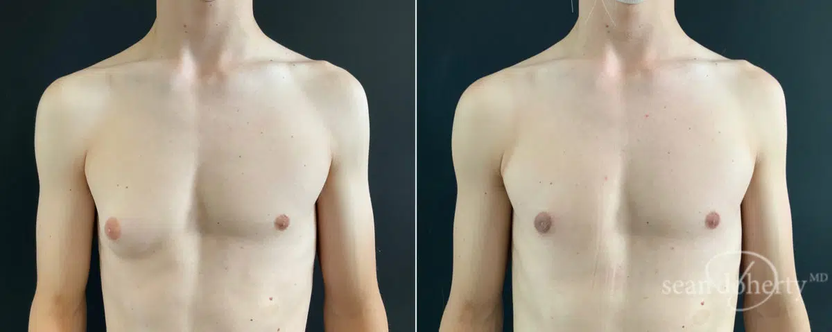 Gynecomastia Before and After Photos in Boston, MA, Patient 8451