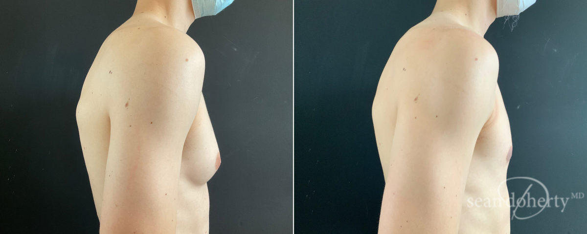 Gynecomastia Before and After Photos in Boston, MA, Patient 8451