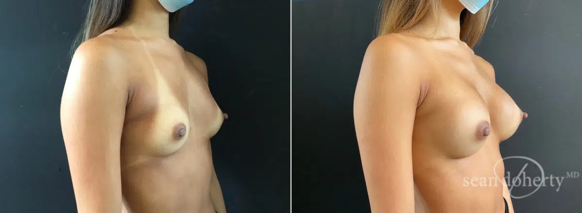 Breast Augmentation Before and After Photos in Boston, MA, Patient 8461