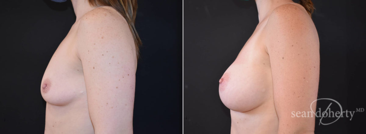 Breast Augmentation Before and After Photos in Boston, MA, Patient 8471