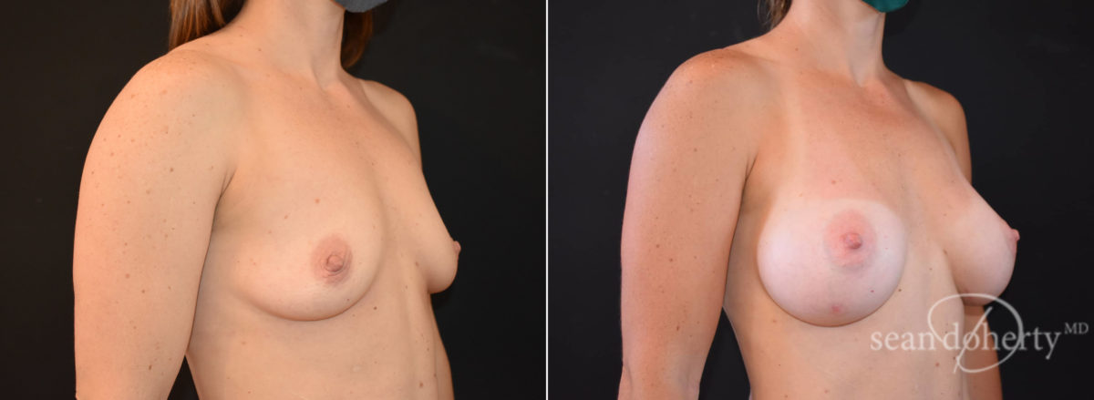 Breast Augmentation Before and After Photos in Boston, MA, Patient 8471