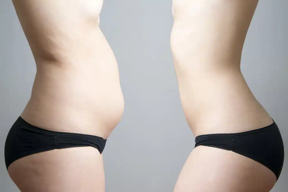 FlexSure™ is a non-invasive body contouring treatment that uses controlled radiofrequency (RF) energy to heat and rejuvenate tissue and reduce fat.