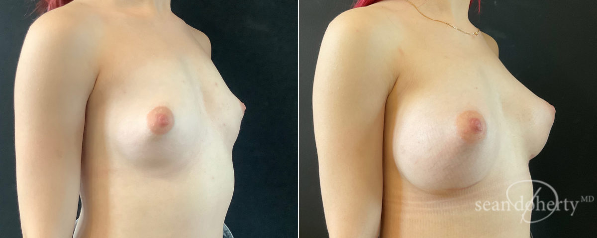 Breast Augmentation Before and After Photos in Boston, MA, Patient 7626