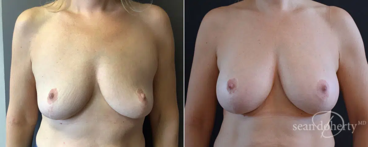 Patient 7636, Breast Augmentation Before and After Photos Breast Augmentation Before and After Photos in Boston, MA, Patient 7636