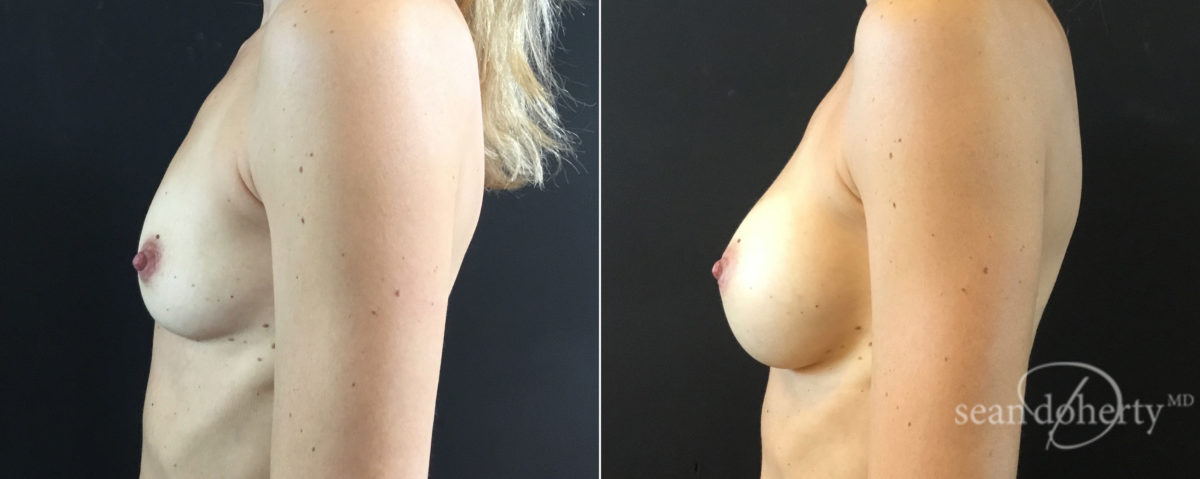 Breast Augmentation Before and After Photos in Boston, MA, Patient 7646