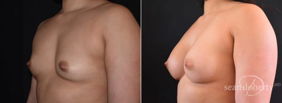 Breast Augmentation Before and After Photos in Boston, MA, Patient 7684