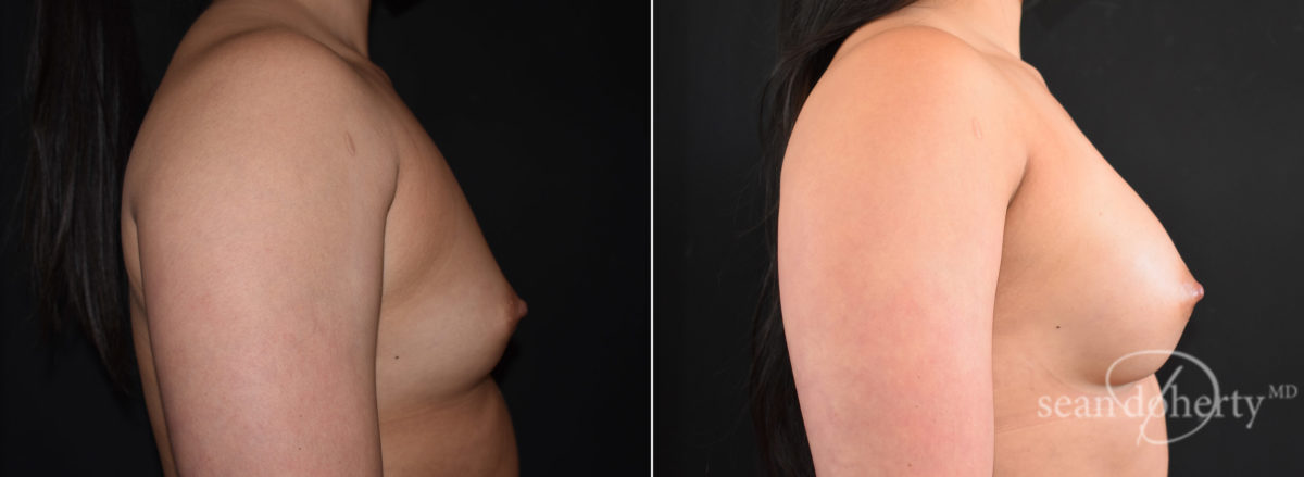 Breast Augmentation Before and After Photos in Boston, MA, Patient 7684