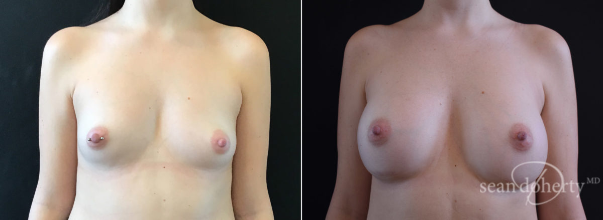 Breast Augmentation Before and After Photos in Boston, MA, Patient 7694