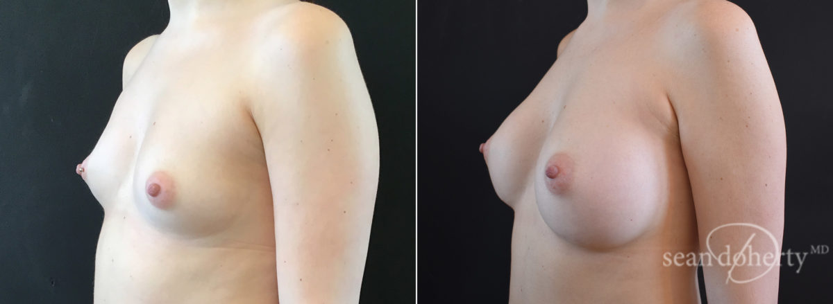 Breast Augmentation Before and After Photos in Boston, MA, Patient 7694