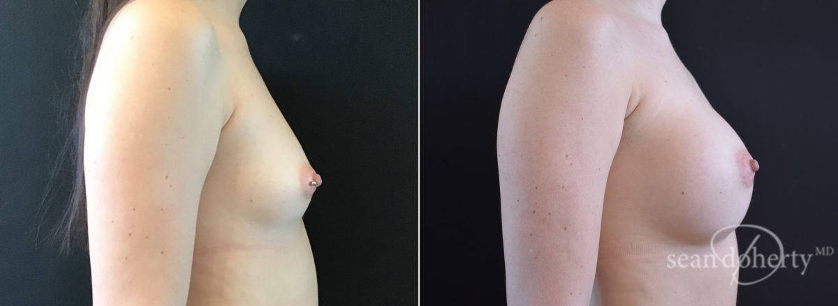 Breast Augmentation Before and After Photos in Boston, MA, Patient 7694