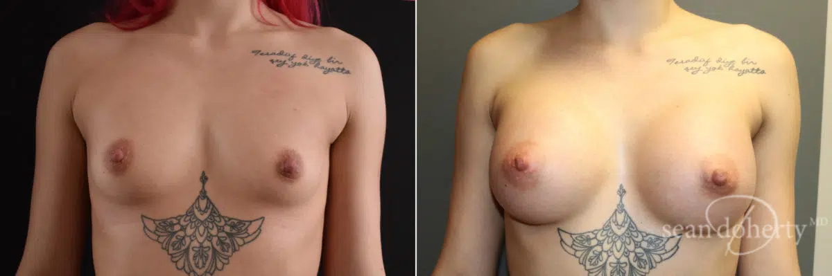 Breast Augmentation Before and After Photos in Boston, MA, Patient 7706