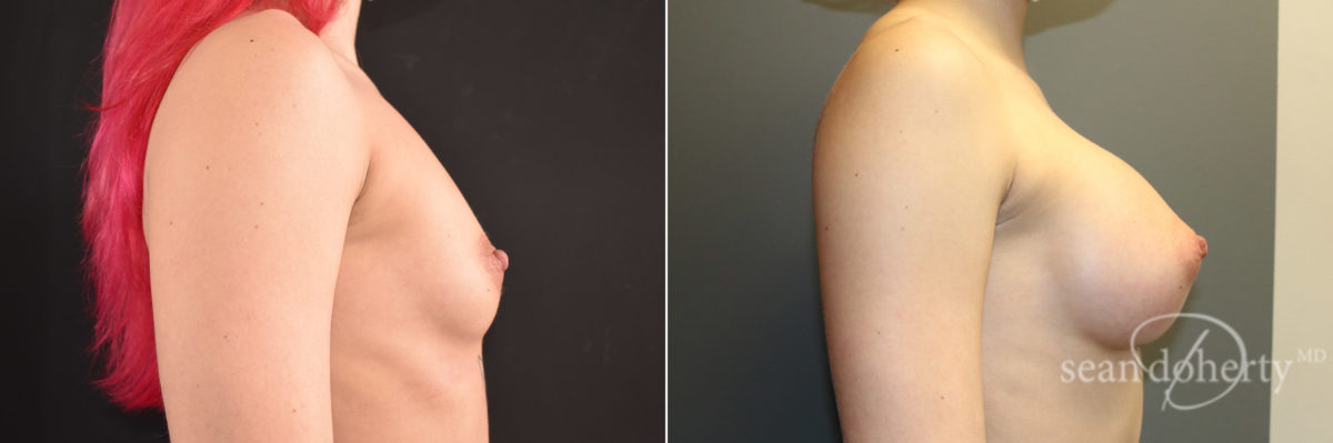 Breast Augmentation Before and After Photos in Boston, MA, Patient 7706