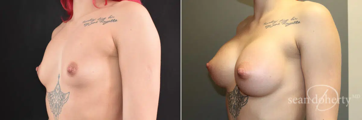 Breast Augmentation Before and After Photos in Boston, MA, Patient 7706