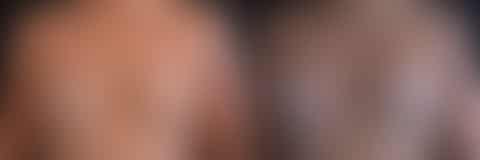 Breast Augmentation Before and After Photos in Boston, MA, Patient 7716