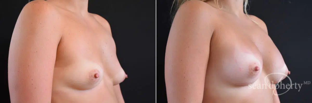 Breast Augmentation Before and After Photos in Boston, MA, Patient 7716