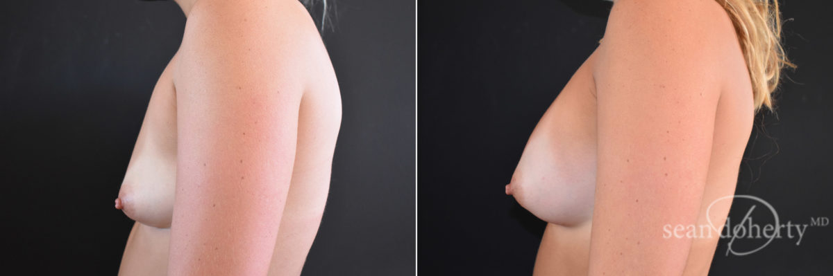 Breast Augmentation Before and After Photos in Boston, MA, Patient 7716