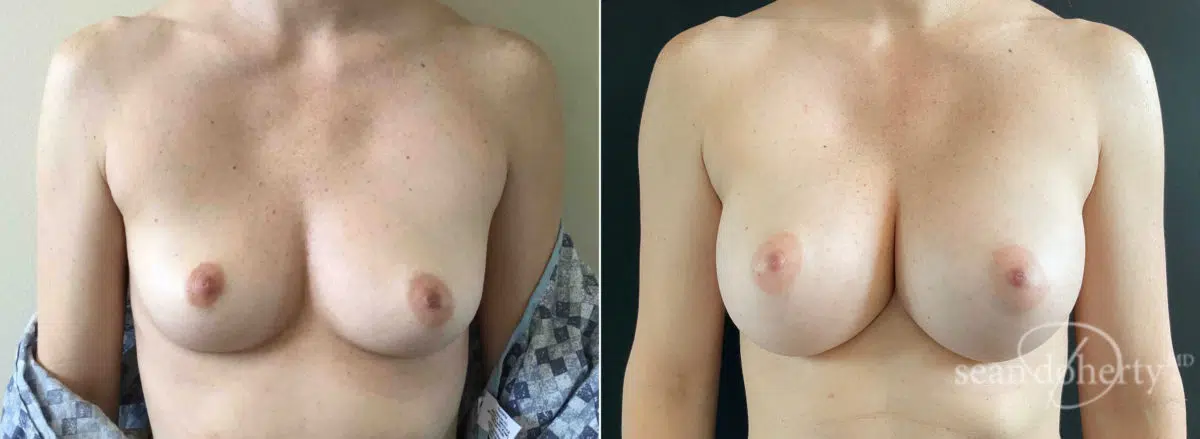 Breast Augmentation Before and After Photos in Boston, MA, Patient 7755