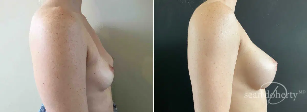 Breast Augmentation Before and After Photos in Boston, MA, Patient 7755