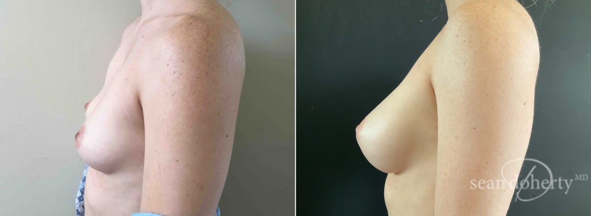 Breast Augmentation Before and After Photos in Boston, MA, Patient 7755