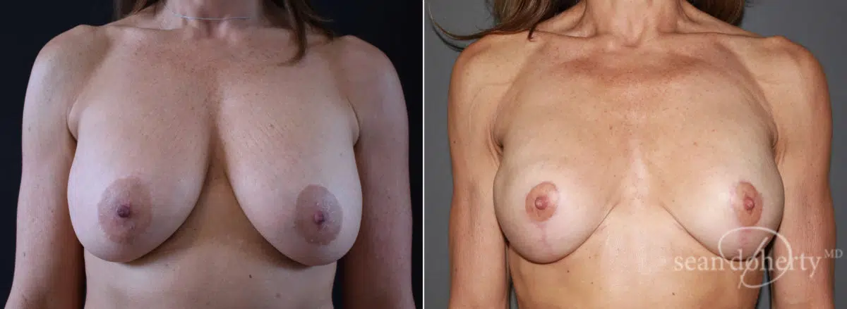 Breast Lift Before and After Photos in Boston, MA, Patient 7757