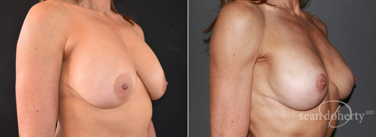 Breast Lift Before and After Photos in Boston, MA, Patient 7757