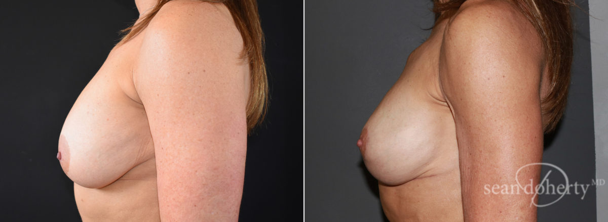 Breast Lift Before and After Photos in Boston, MA, Patient 7757