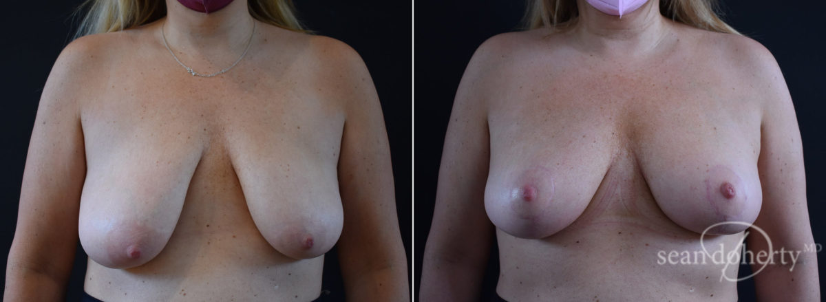 Breast Lift Before and After Photos in Boston, MA, Patient 8434