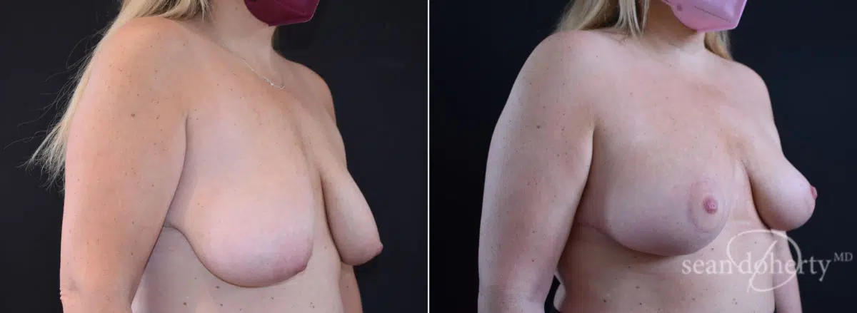 Breast Lift Before and After Photos in Boston, MA, Patient 8434