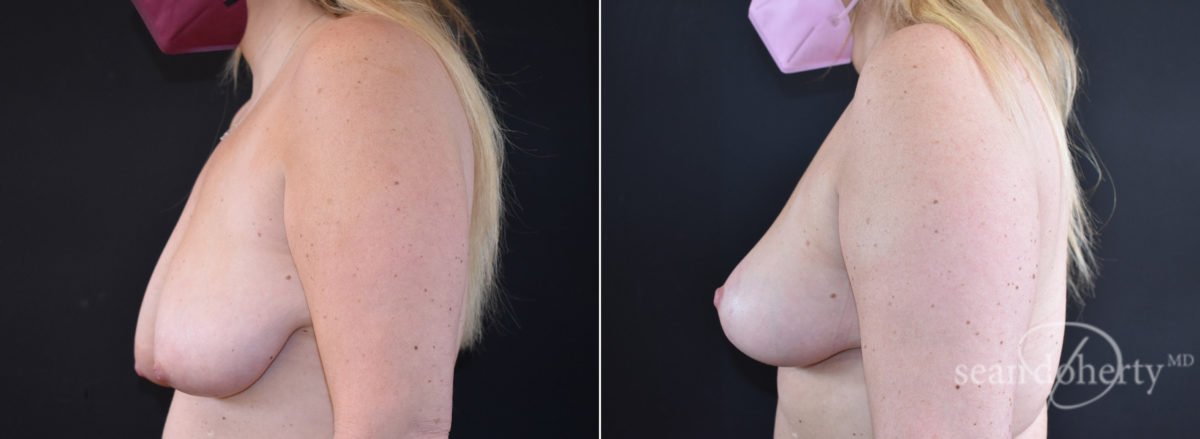 Breast Lift Before and After Photos in Boston, MA, Patient 8434