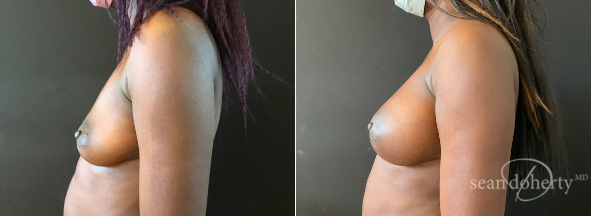 Breast Augmentation Before and After Photos in Boston, MA, Patient 8730