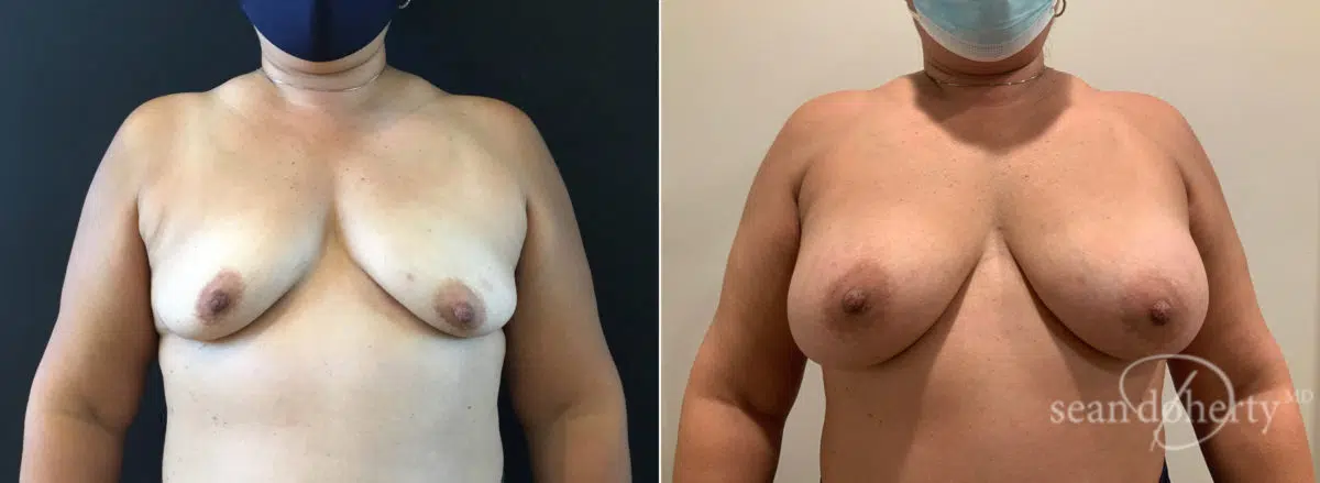 Breast Augmentation Before and After Photos in Boston, MA, Patient 8765