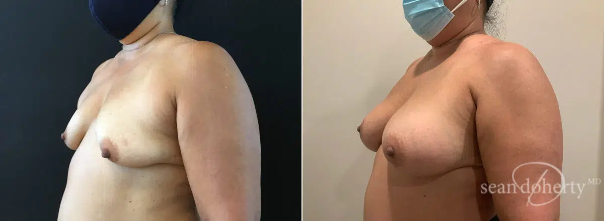 Breast Augmentation Before and After Photos in Boston, MA, Patient 8765