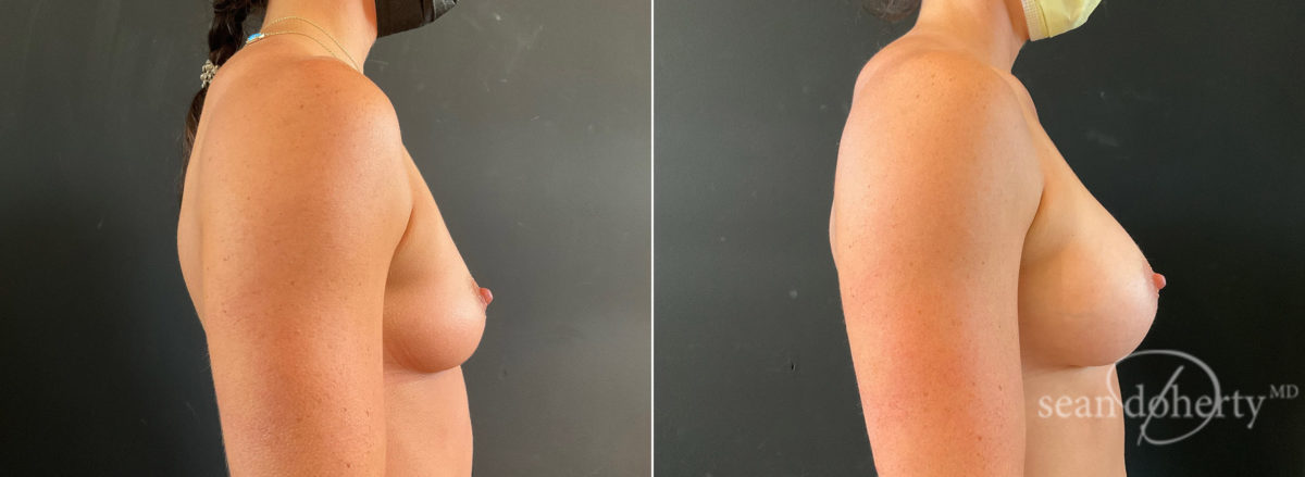 Breast Augmentation Before and After Photos in Boston, MA, Patient 8798