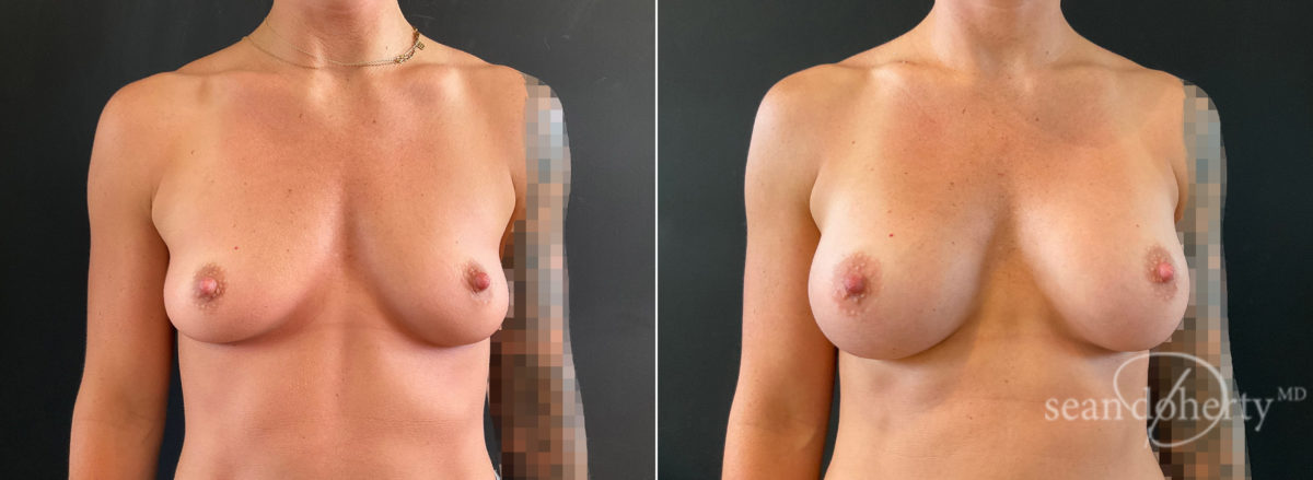 Breast Augmentation Before and After Photos in Boston, MA, Patient 8798