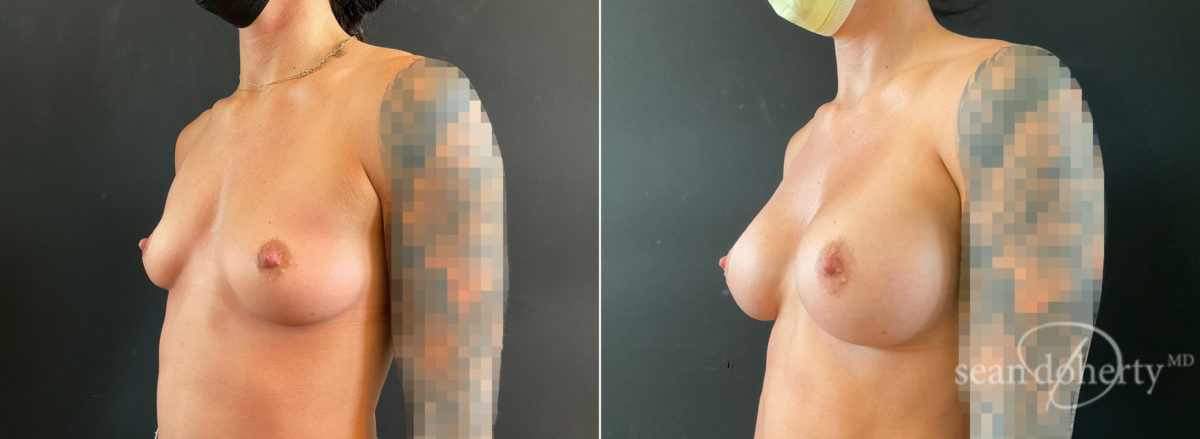 Breast Augmentation Before and After Photos in Boston, MA, Patient 8798