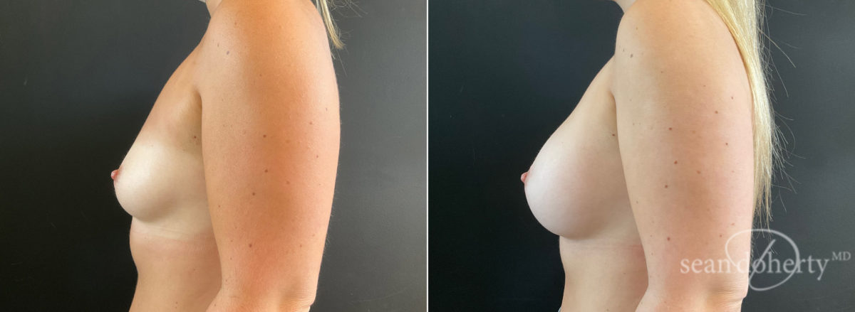 Breast Augmentation Before and After Photos in Boston, MA, Patient 8828