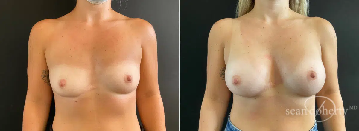 Breast Augmentation Before and After Photos in Boston, MA, Patient 8828